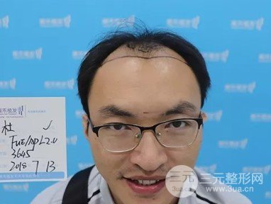 植发的价钱大概多少