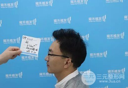 植发的价钱大概多少