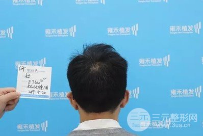 植发的价钱大概多少