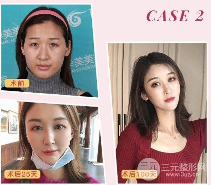 大拉皮手术能维持多久