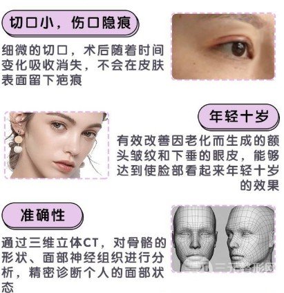 大拉皮手术能维持多久