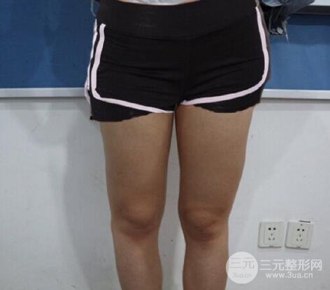 大腿吸脂