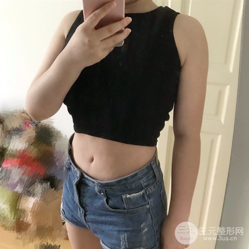 腰腹+大腿吸脂