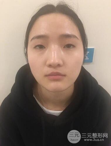 阜阳眼部整形案例反馈