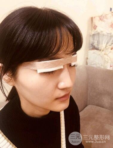 阜阳眼部整形案例反馈