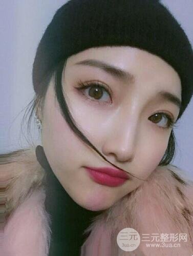 阜阳眼部整形案例反馈