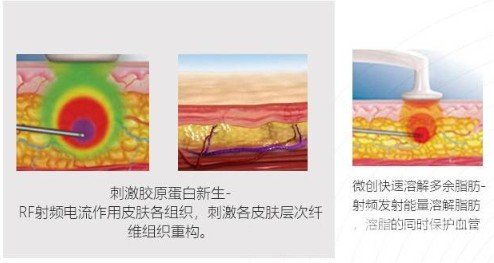 等离子激光溶脂果如何