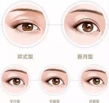 激光双眼皮能保持几年