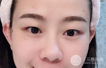 激光双眼皮能保持几年