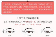 上睑下垂术后眼睛闭不上怎么办?这种现象会持续多久? 上睑下垂术后眼睛闭不上怎么办?这种现象会持续多久?