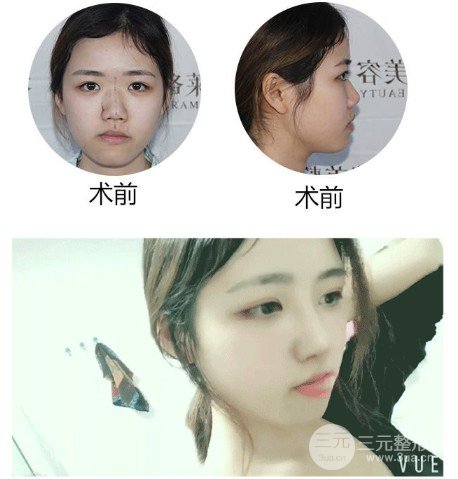垫鼻子好不好