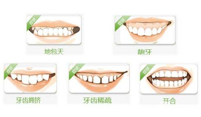 　科普：为什么需要牙齿矫正