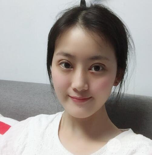 临沂瑞丽美容医院双眼皮案例欣赏