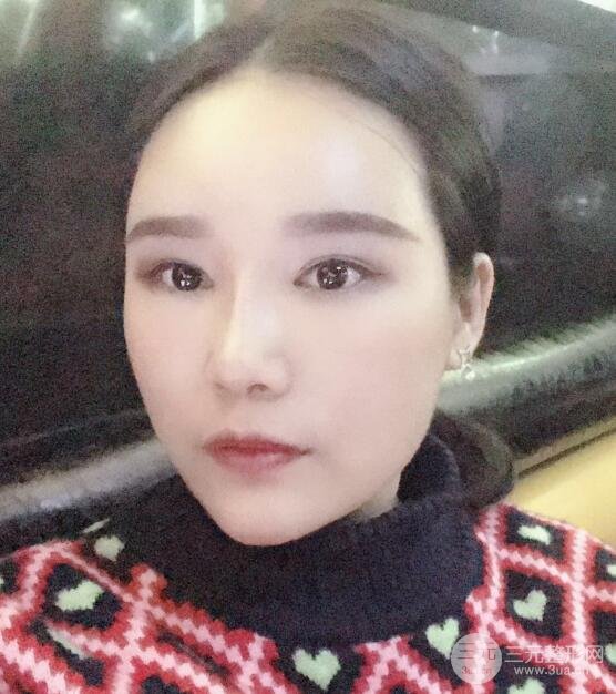 丰太阳穴手术后