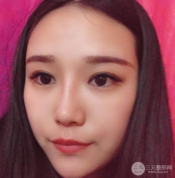 丰太阳穴手术后