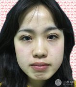 耳软骨垫鼻尖失败照片|鼻修复经历,鼻子第二次重生~ 耳软骨垫鼻尖失败照片|鼻修复经历,鼻子第二次重生~