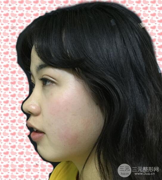 耳软骨垫鼻尖失败手术前