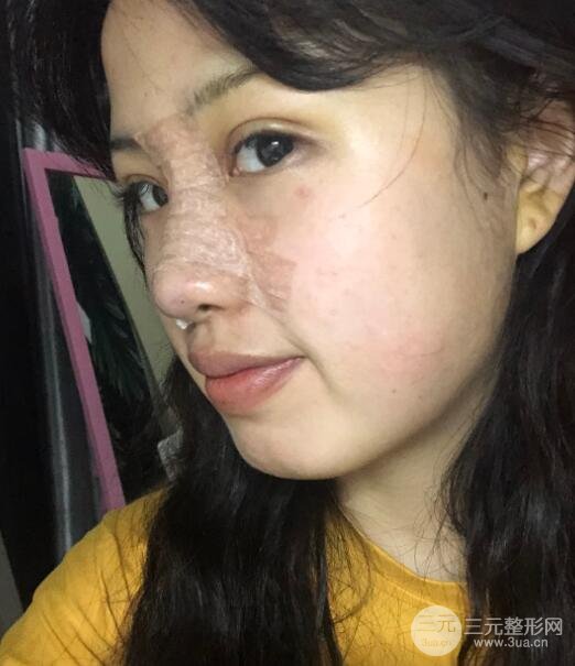 耳软骨垫鼻尖失败手术前