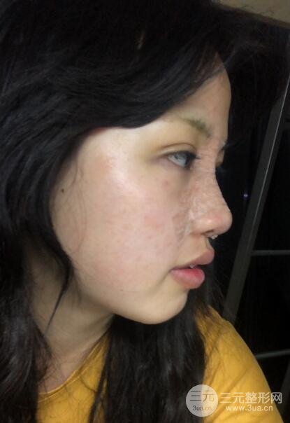 耳软骨垫鼻尖失败手术前