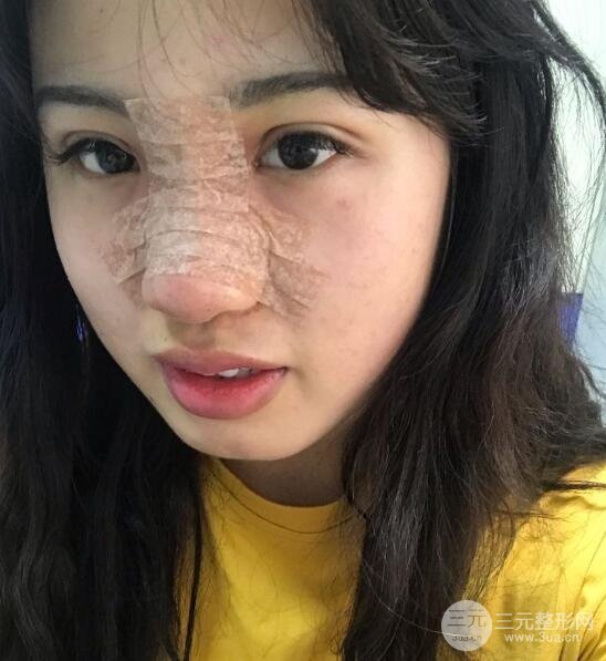 耳软骨垫鼻尖失败手术时