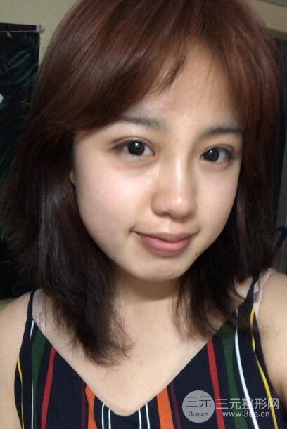 耳软骨垫鼻尖失败手术后