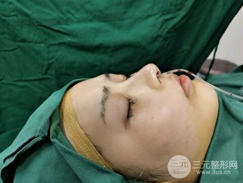 缩鼻头和鼻翼手术时