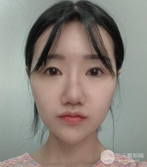 缩鼻头和鼻翼手术后