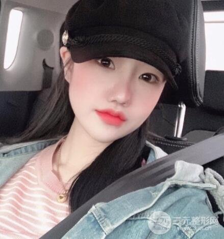 缩鼻头和鼻翼手术后