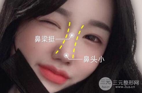 缩鼻头和鼻翼手术后