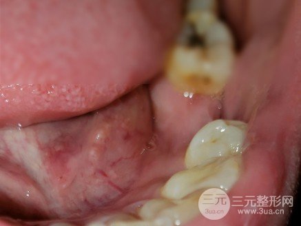 装烤瓷牙有什么后遗症