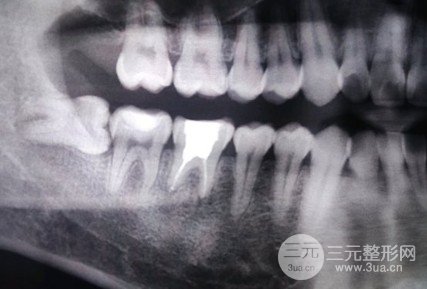 装烤瓷牙有什么后遗症