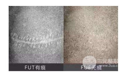 fut植发技术优缺点