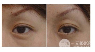 抽脂去眼袋费用贵