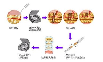 自体脂肪丰胸和假体丰胸