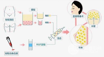 自体脂肪丰胸和假体丰胸