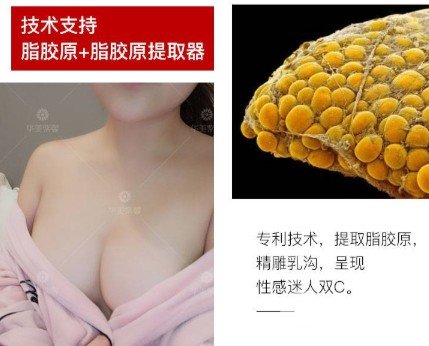 自体脂肪丰胸和假体丰胸