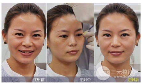 消除鱼尾纹的方法有哪些