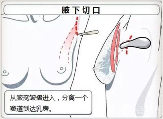 假体曼陀型号照片