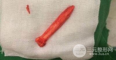 鼻部整形手术的可靠性