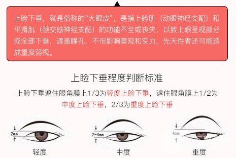 上睑下垂恢复