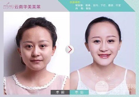 打注射瘦脸的危害大吗