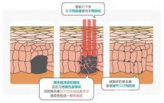 激光美白大约要花多少钱？一次有多久【保鲜期】?
