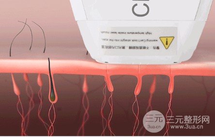 光子脱毛的危害有哪些