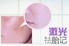 如何去掉胎记？来看看三甲医院的方法~