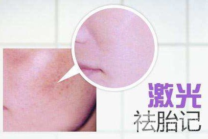 如何去掉胎记