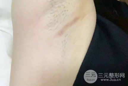 自体脂肪丰胸恢复期多久