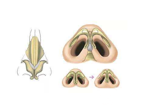 怎么让鼻头缩小