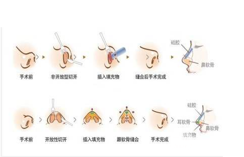 怎么让鼻头缩小