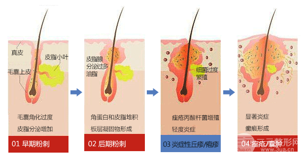 水杨酸祛痘的原理