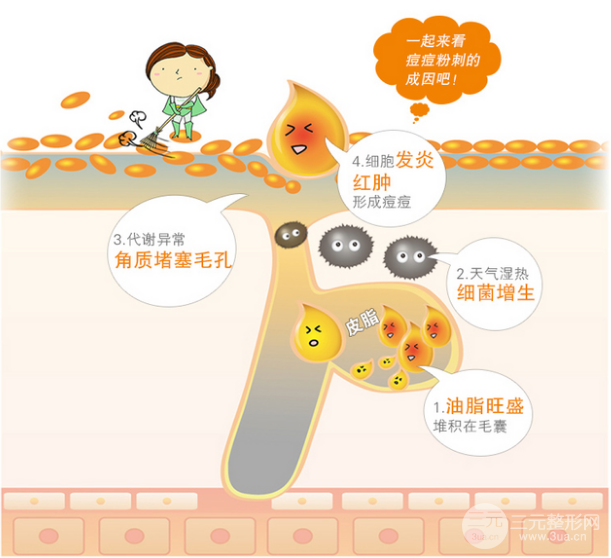 水杨酸祛痘的原理